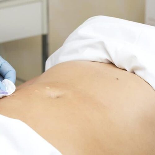 Mesoterapia y Presoterapia: ¿Se pueden combinar?