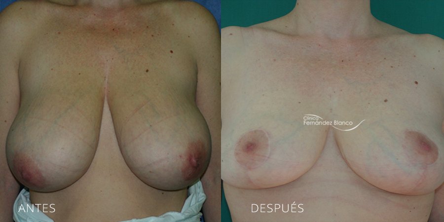 Reducción de mamas Caso 14