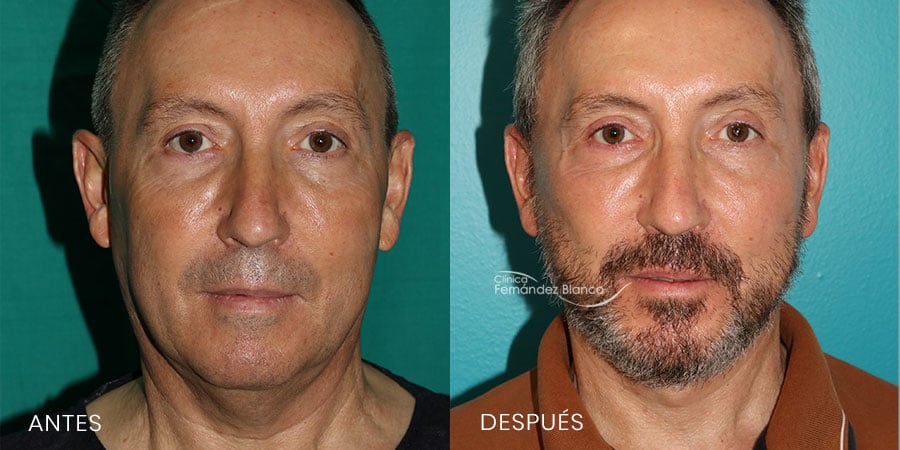 Lifting Facial Antes y Después