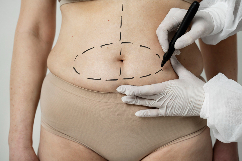 ¿Para quién está indicada la liposucción ultrasónica?