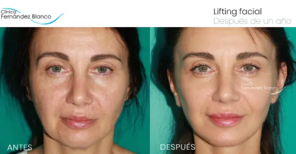 Mini Lifting Facial: rejuvenece 10 años en 2 horas