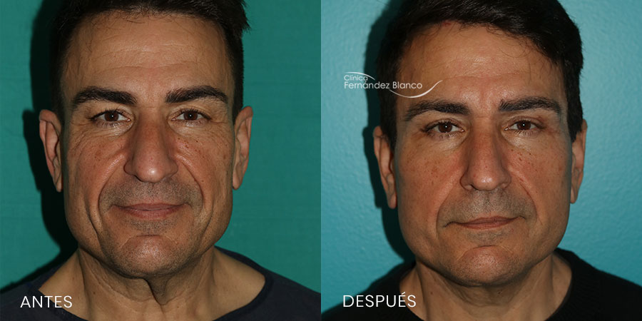 Lifting Facial Antes y Después