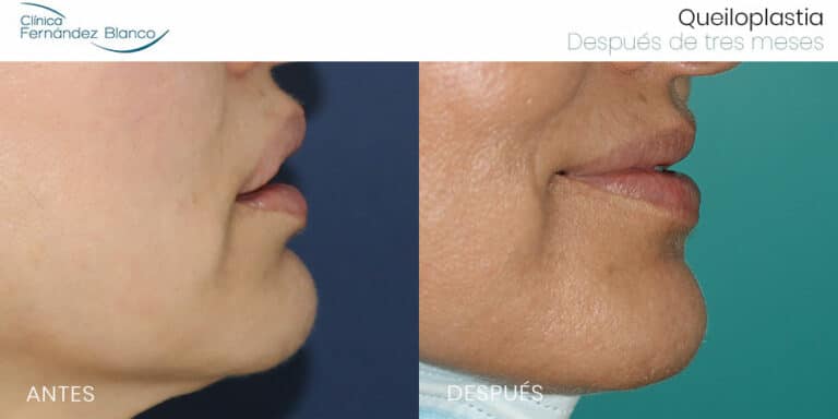 Extracción De Biopolímeros En Labios Caso 30 Dr Fernandez Blanco 8941