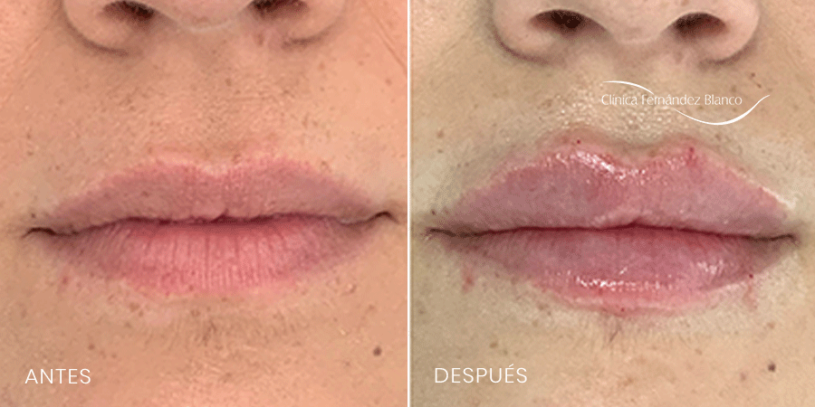 Antes y despues de ácido hialurónico labios