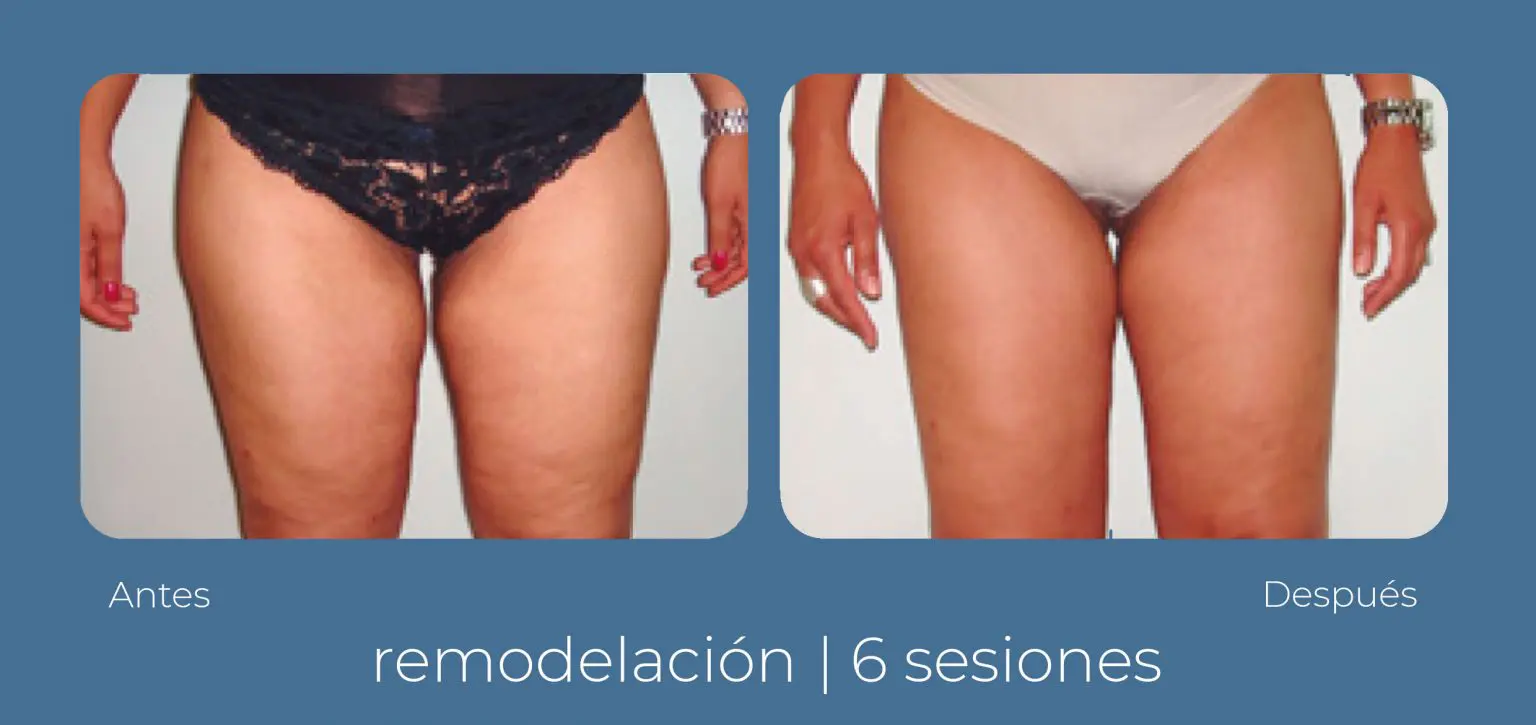 Conoce cómo quitar celulitis en piernas con INDIBA