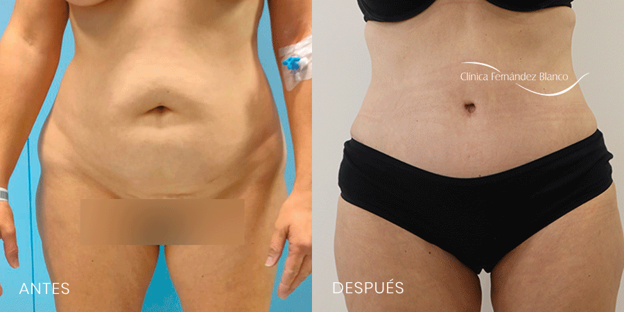 Abdominoplastia caso 17