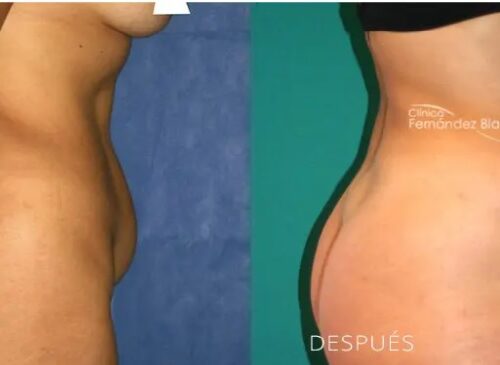 Preguntas frecuentes acerca del antes y después abdominoplastia