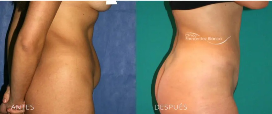 Dudas frecuentes sobre abdominoplastia