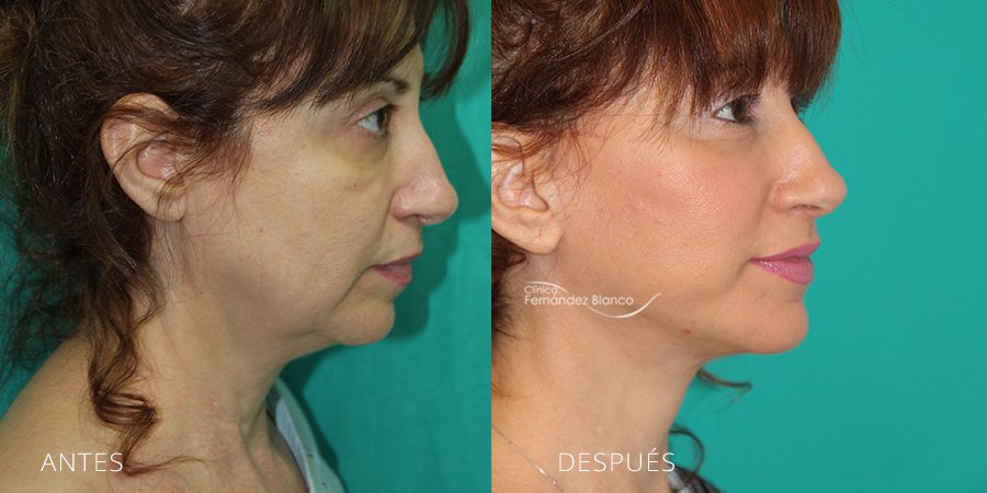 Lifting cervico-facial