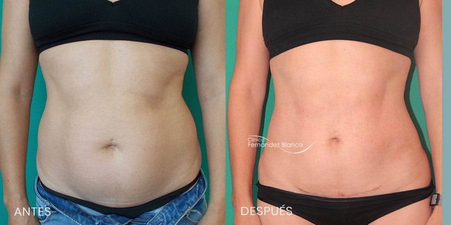 mini-abdominoplastia-dr-fernandez-blanco