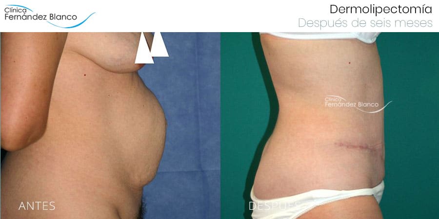 Para qué sirve una abdominoplastia y quién la necesita