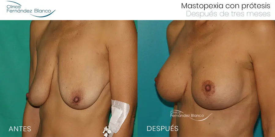 Mastopexia sin cicatriz: El tema principal de la 45th Annual Baker&Gordon Symposium en Miami