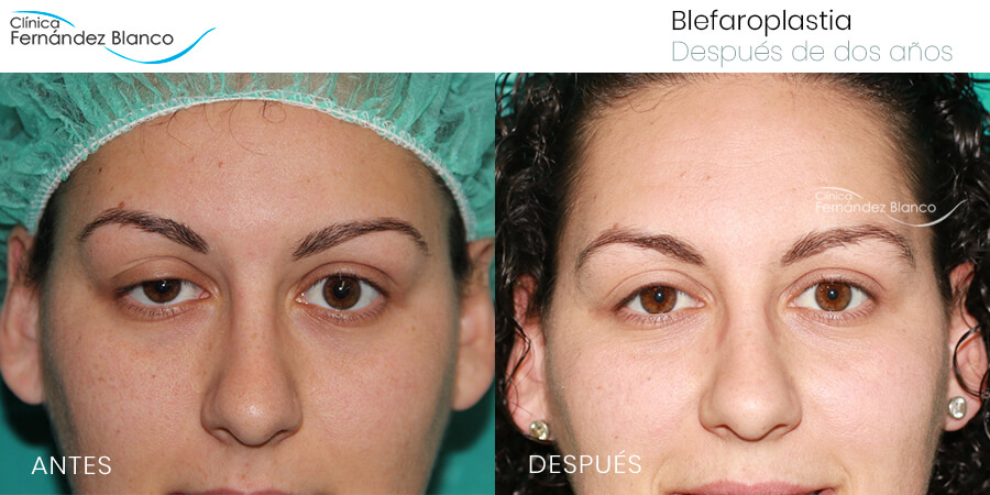 Blefaroplastia: cirugía de párpados