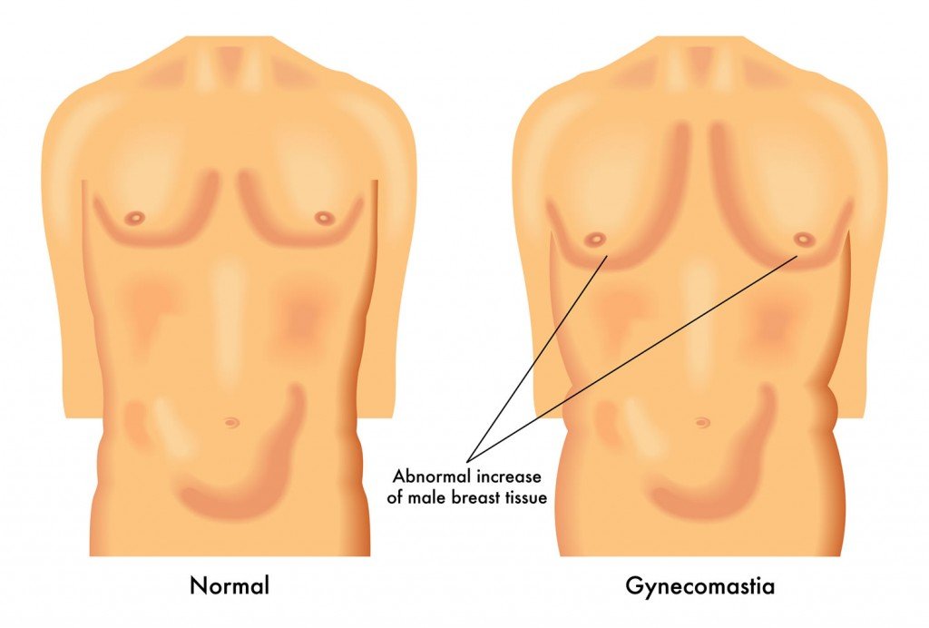 ¿La ginecomastia requiere siempre de una ginecoplastia?