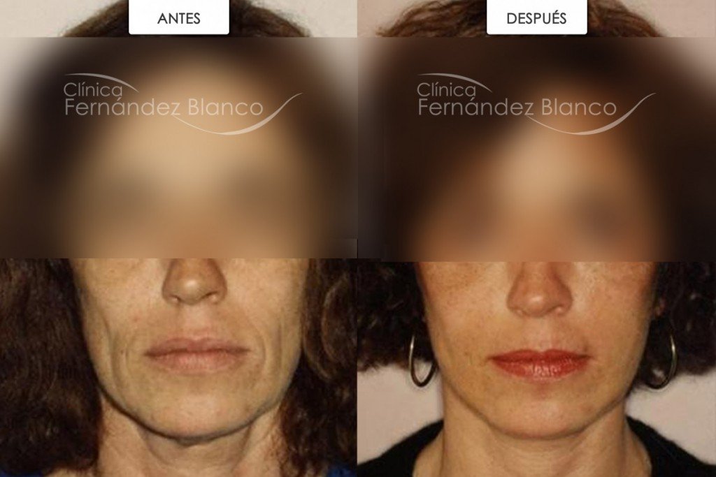 Reequilibrando el volumen facial: injerto de grasa en las mejillas