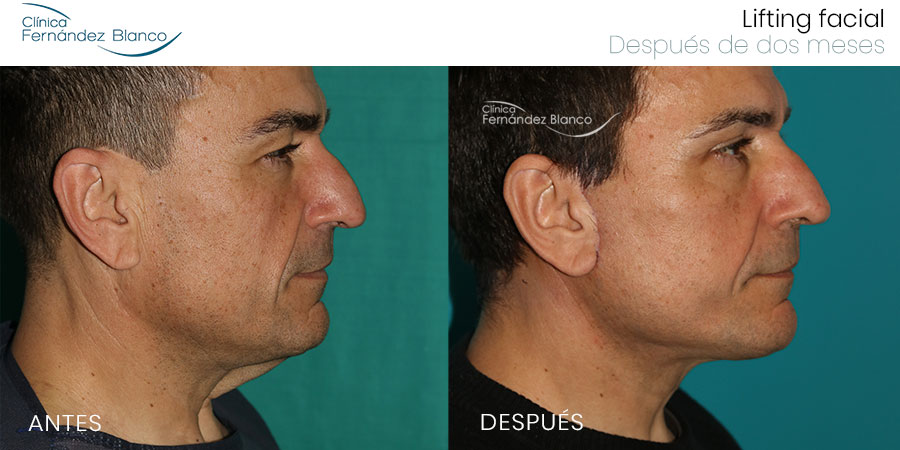 Lifting cervical precio 2023 | Fotografías de antes y después de un lifting facial