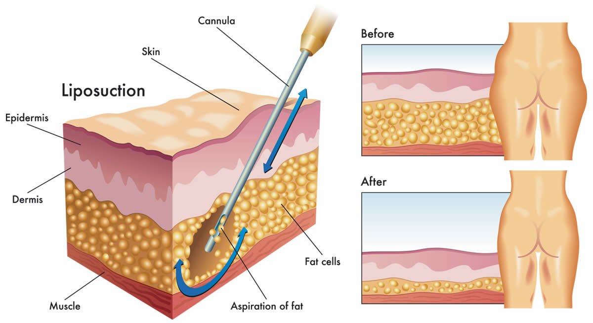 La razón de ser de la liposucción