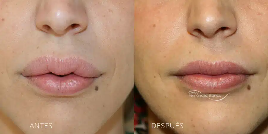 Biopolímeros labios antes y después