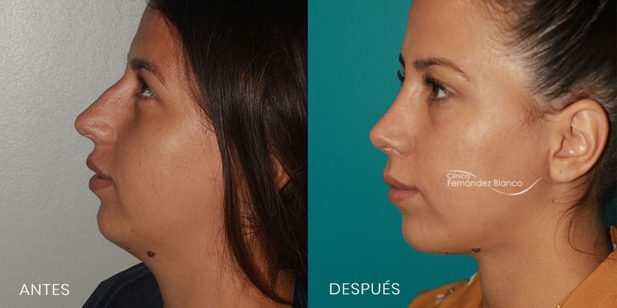 ¿Por qué la rinoplastia está de moda?