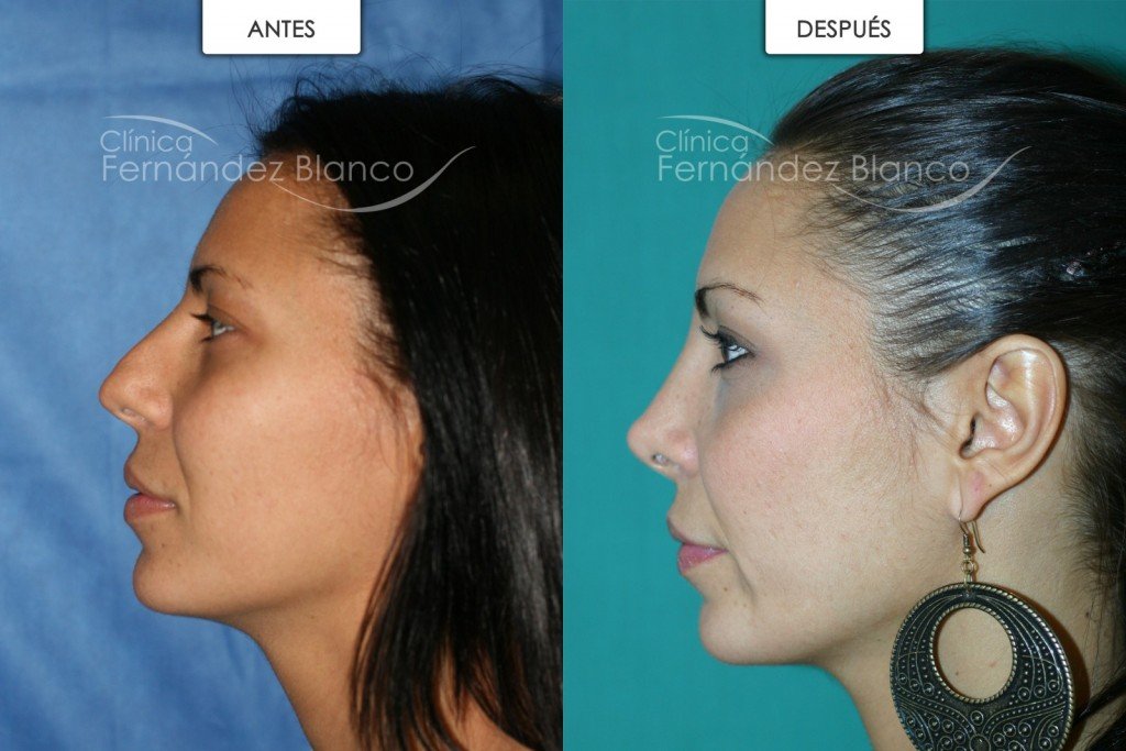 Rinoplastia sí, pero no por narices