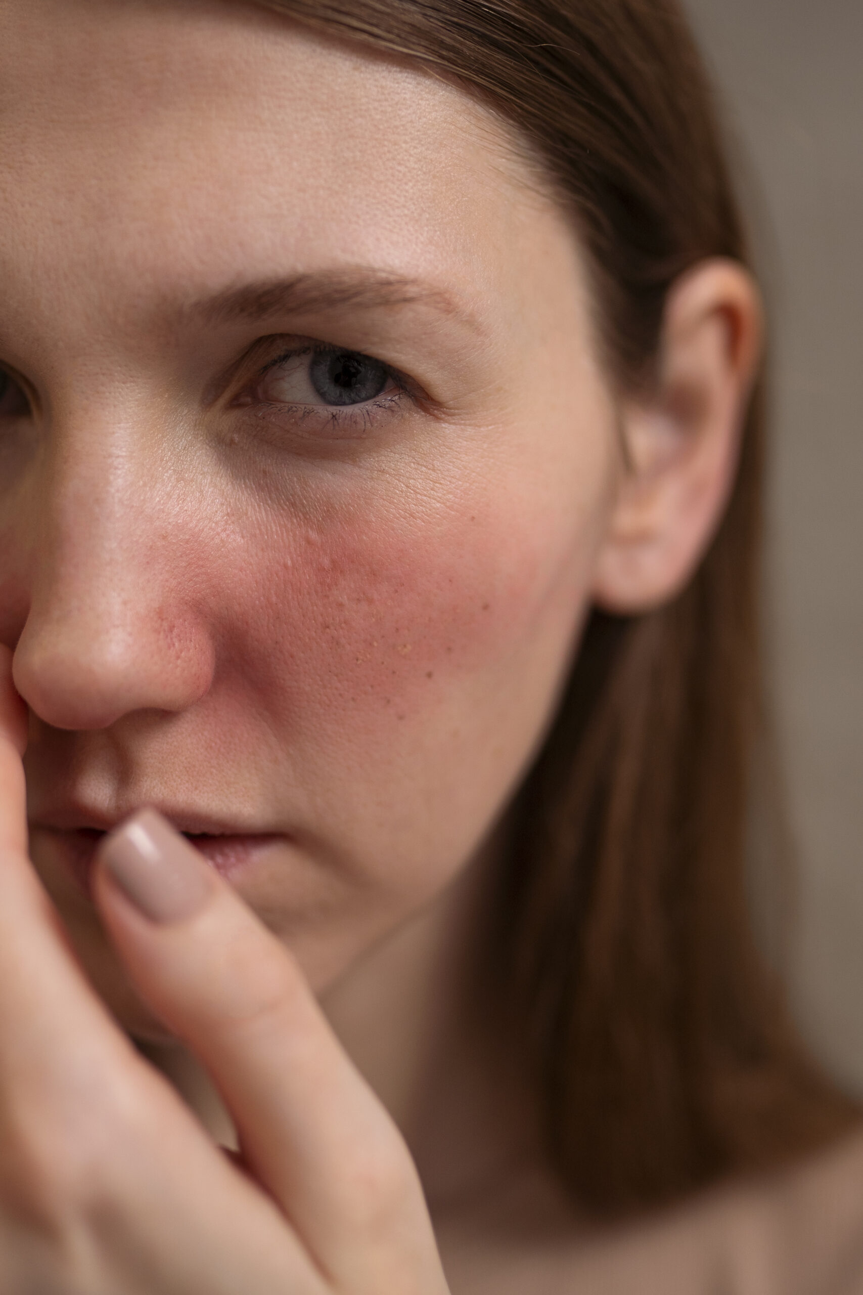 Rosácea en la cara tratamiento: Te compartimos 5 trucos de belleza que te ayudarán a reducir el enrojecimiento facial