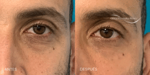 Ojeras-oscuras-como-quitarlas-dr-fernandez-blanco