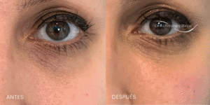 ojeras-como-quitarlas-dr-fernandez-blanco