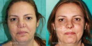 rinoplastia-mal-hecha-dr-fernandez-blanco