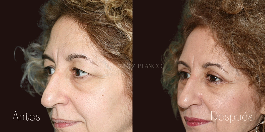 Foto del antes y después de una blefaroplastia superior realizada a Sandra por el Dr. Fernández Blanco