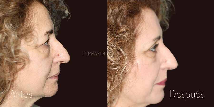 Foto de perfil derecho de Sandra del antes y después de realizarse una blefaroplastia superior e inferior en la Clínica Fernández Blanco