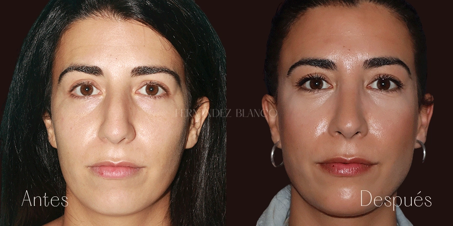 Antes y después de rinoplastia cerrada realizada por el Dr. Fernández Blanco a la paciente Carmen