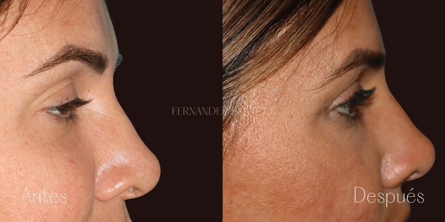 Antes y después del perfil derecho de Abigail tras hacerse una blefaroplastia superior con 3 meses de evolución por el Dr. Fernández Blanco