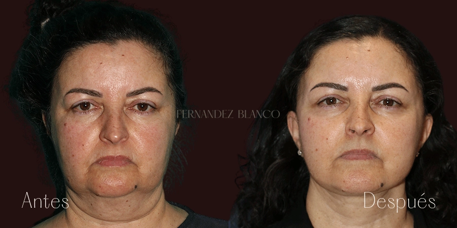 Antes y después de Nicole, quien se realizo un lifting completo con liposucción de papada