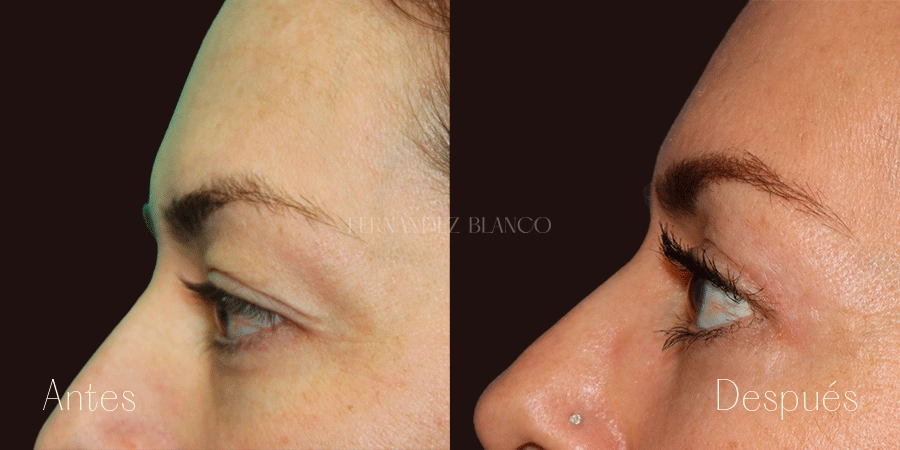 Antes y después de blefaroplastia superior con 3 meses de evolución realizado a paciente Diana por el Dr. Alfredo Fernández Blanco