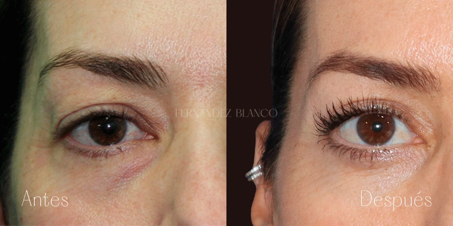 Antes y después de la vista frontal de Diana tras realizarse una pequeña blefaroplastia superior en la Clínica Fernández Blanco