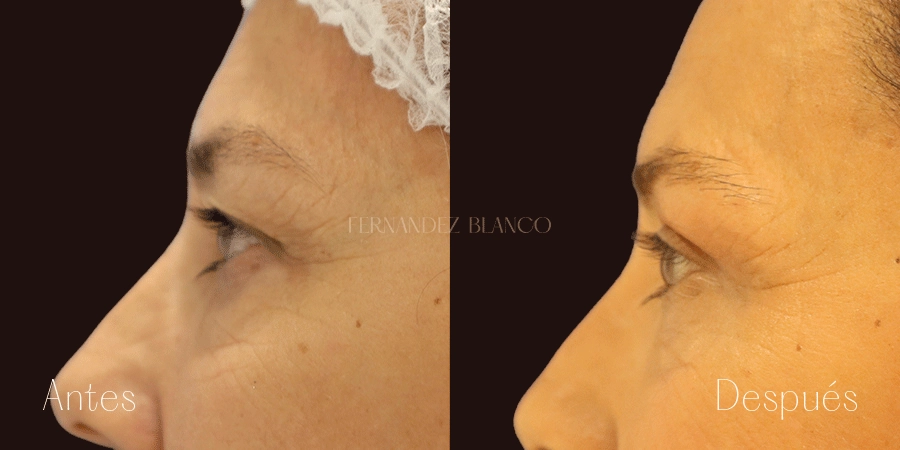 Perfil izquierdo del antes y después de una cirugía de blefaroplastia superior realizada por la Dra. Patricia López Santos