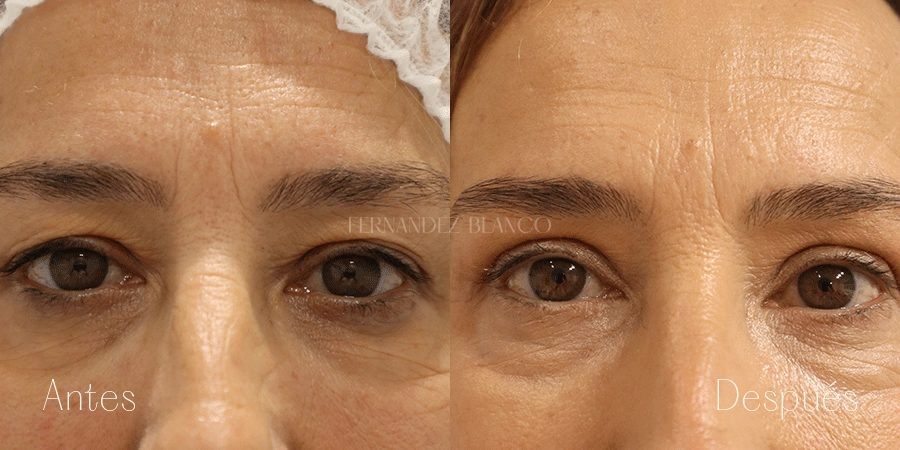 Antes y después de Judith tras hacerse una blefaroplastia superior con la Dra. Patricia López Santos