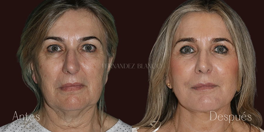 Vista frontal del antes y después de Elizabeth, quien se hizo un lifting de cara y cuello con el Dr. Fernández Blanco