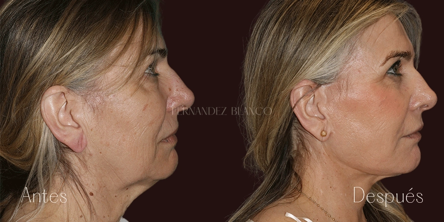 Lifting de cara y cuello realizado por el Dr. Fernández Blanco con 3 meses de evolución