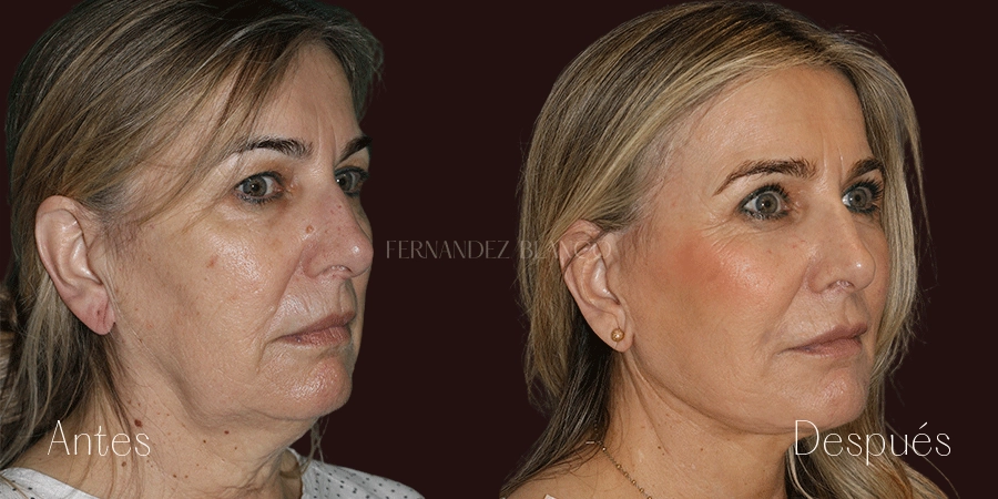 Antes y después de un lifting de cara y cuello realizado por el Dr. Fernández Blanco a la paciente Elizabeth