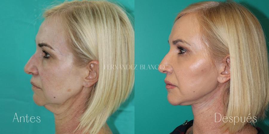 Foto del perfil izquierdo de mujer antes y después de lifting facial realizado por el Dr. Fernández Blanco