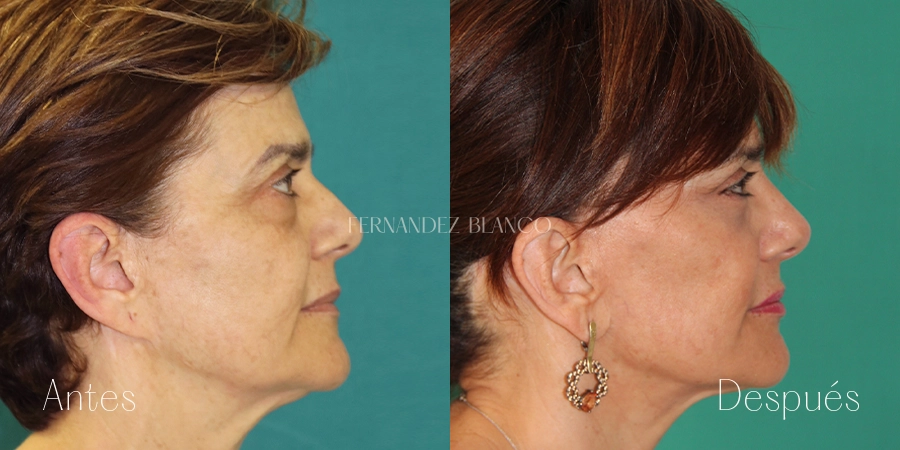 Perfil izquierdo de mujer antes y después de realizarse una cirugía ed lifting cérvico facial en la Clínica FB