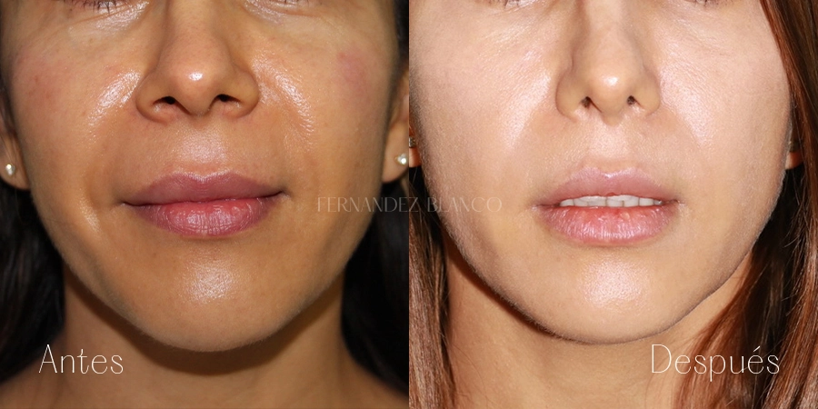 Vista frontal del antes y después de Liplift, también conocido como acortamiento de labio superior