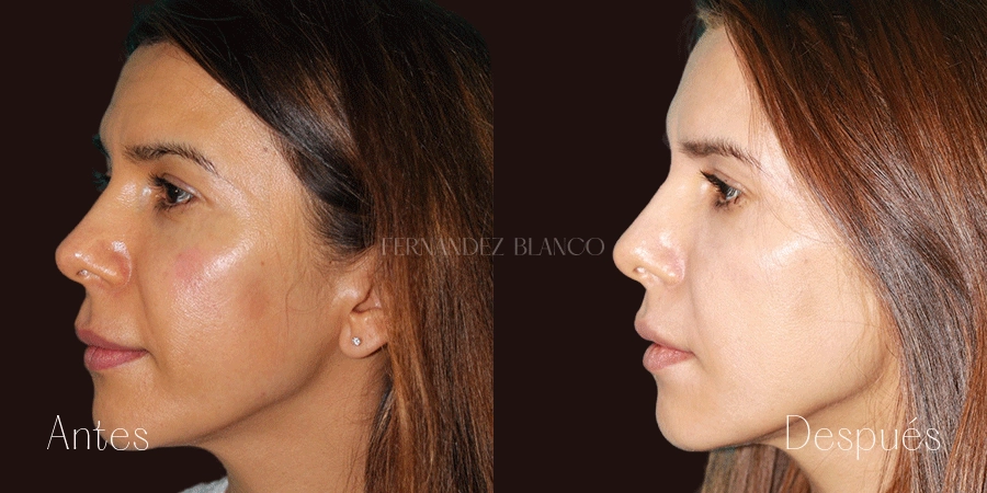 Liplift realizado en la Clínica Fernández Blanco. Fotografía tomada desde el perfil izquierdo antes y después