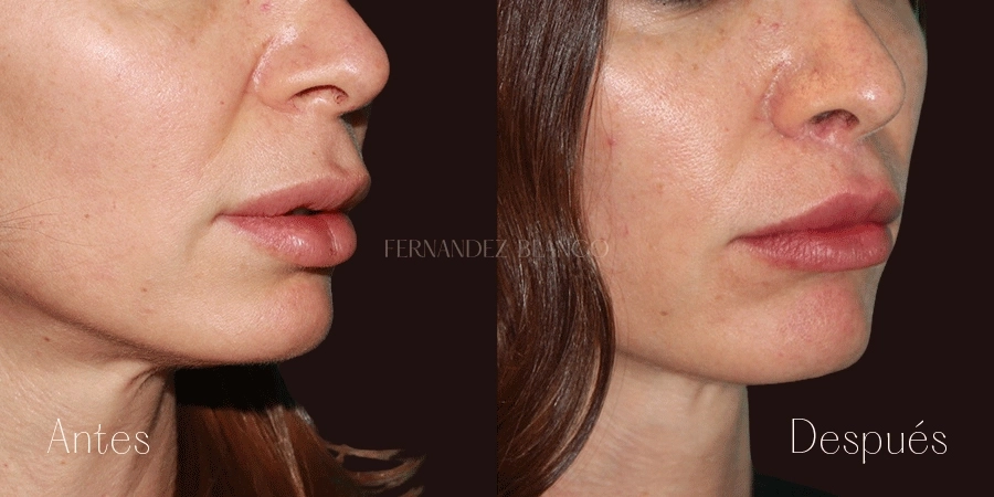 Fotografía del antes y después de Esther tras realizarse una cirugía de Liplift en la Clínica Fernández Blanco