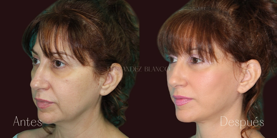 Perfil medio izquierdo de Mónica antes y después de hacerse un lifting completo con el Dr. Fernández Blanco