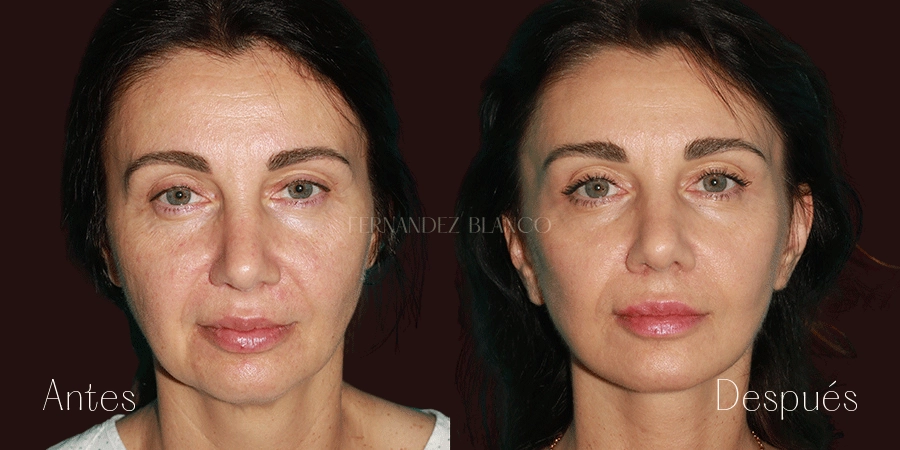 Vista frontal del antes y después de Nayeli tras realizarse un lifting cervico facial en la Clínica Fernández Blanco