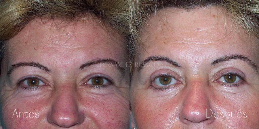 Vista frontal del antes y después de una blefaroplastia superior e inferior, también conocido como blefaroplastia completa