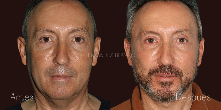 Vista frontal del antes y después de un lifting de cuello y mejilla realizado en la Clínica Fernández Blanco