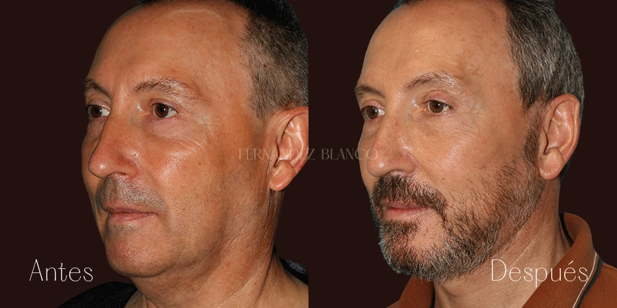 Antes y después de una operación de lifting para rejuvenecer el cuello y mejilla de Javier